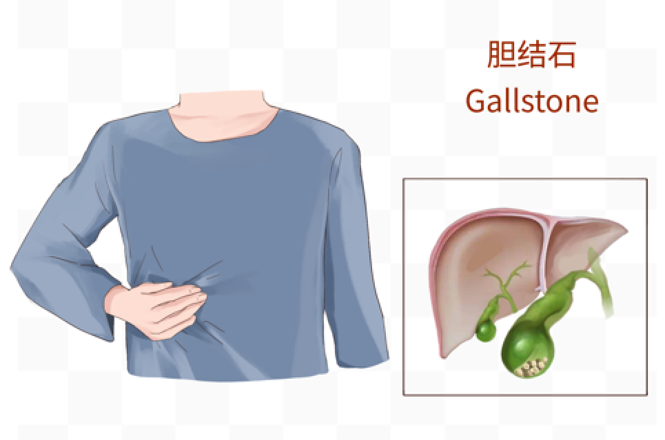 【羊城晚报】冬至可别胡吃海喝！小心这个“吃货病”（不是肠胃炎）