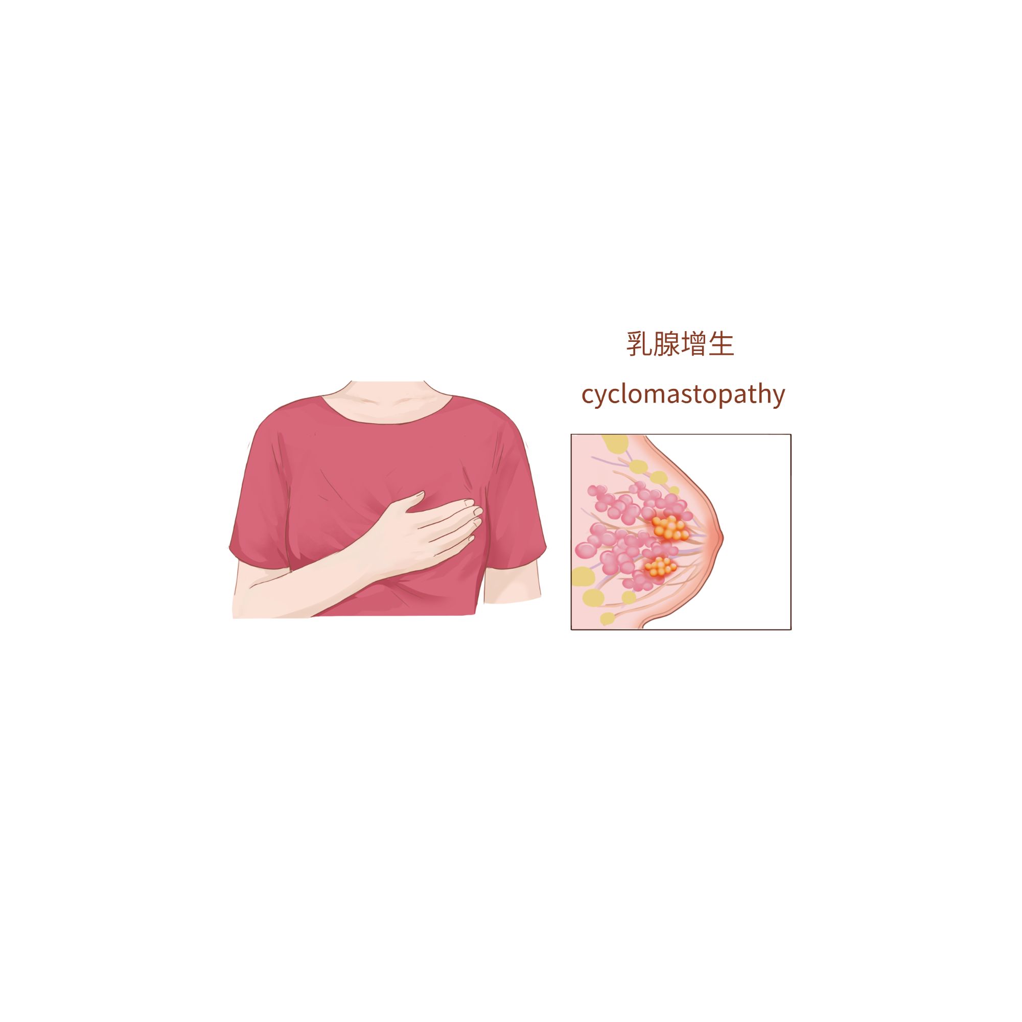 近4成广东女性检出乳腺结节？怎么办？