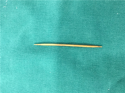 男子下腹隐痛4月余，原来是一根6cm牙签把肠子戳破了