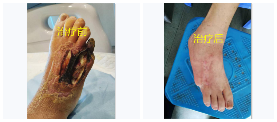 患“糖尿病足”=截肢？祈福医院内分泌科Say no！